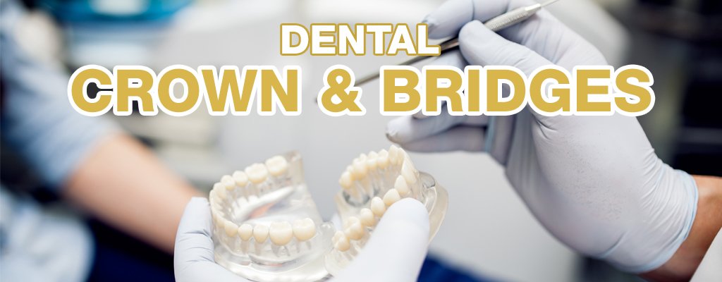 Dental crown and bridges